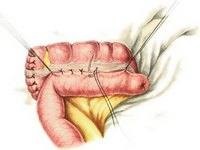 Jobb oldali hemicolectomy 2 (csatlakozik a vékonybélben) Jobb oldali hemicolectomy 2