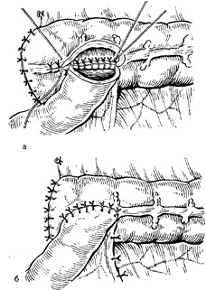 Jobb oldali hemicolectomy 1 (csomóponti selyem varratok) Jobb oldali hemicolectomy 1