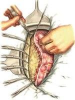 Jobb oldali hemicolectomy 2 (csatlakozik a vékonybélben) Jobb oldali hemicolectomy 2