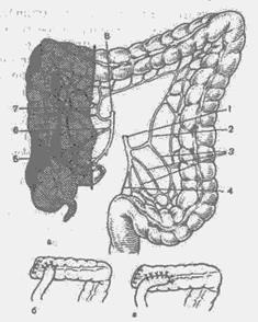 Jobb oldali hemicolectomy 1 (hemicolectomy) Jobb oldali hemicolectomy 1