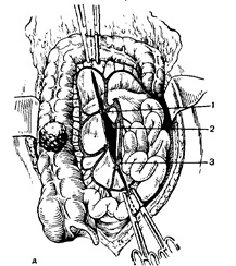 Jobb oldali hemicolectomy 1 (jobbra) Jobb oldali hemicolectomy 1