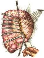 Jobb oldali hemicolectomy 2 (csatlakozik a vékonybélben) Jobb oldali hemicolectomy 2