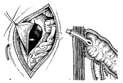 Jobb oldali hemicolectomy 1 (vége a vastagbél) Jobb oldali hemicolectomy 1