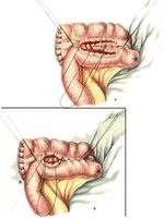 Jobb oldali hemicolectomy 2 (csatlakozik a vékonybélben) Jobb oldali hemicolectomy 2