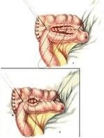 Jobb oldali hemicolectomy 2