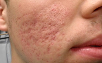 Spots után herpesz, hogyan kell eltávolítani a foltokat és hegeket az arcon