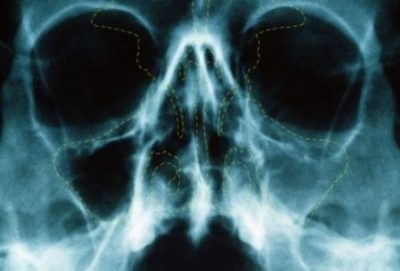 orr röntgen milyen gyakran lehet csinálni, dekódolás röntgen orrmelléküregek