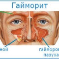Radiológiai orrmelléküregek dekódolás, leírás, fényképek (átirat) Radiológiai orrmelléküregek átirat, leírások, fotók