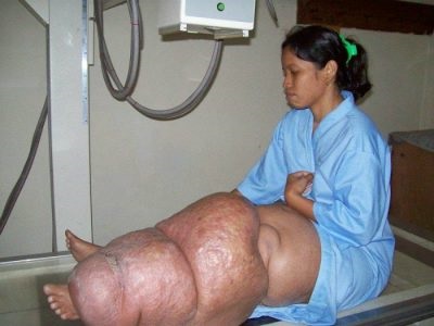 Elephantiasis láb okozza, a kezelés a népi sredsvtami (elephantiasis) Elephantiasis láb okozza, a kezelés a népi sredsvtami