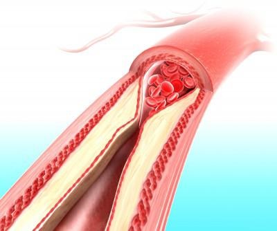 Az angina mi ez, és hogyan diagnosztizálják, e patológia