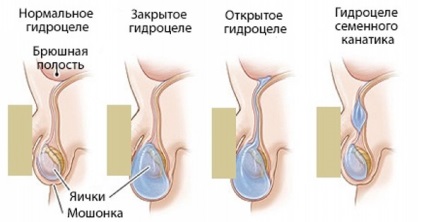 Hydrocele a gyermek okoz, tünetei, kezelése, üzemeltetése, hatások, fotó, videó (tünetek) Hydrocele a gyermek okoz, tünetei, kezelése, üzemeltetése, hatások, fotó, videó