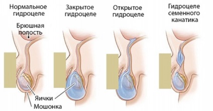 Hydrocele a gyermek okoz, tünetei, kezelése, üzemeltetése, hatások, fotó, videó