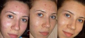 Kémiai hámlasztás az arc az utastérben a technikát alkalmazva, előtt és után, az ajánlások (peeling) Kémiai hámlasztás az arc az utastérben a technikát alkalmazva, előtt és után, az ajánlások