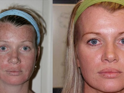Kémiai hámlasztás az arc az utastérben a technikát alkalmazva, előtt és után, az ajánlások (mély peeling arc fotó szalon után a kémiai peeling felület felülvizsgálat) Kémiai hámlasztás az arc az utastérben a technikát alkalmazva, előtt és után, az ajánlások