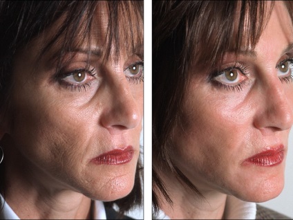 Kémiai hámlasztás az arc az utastérben a technikát alkalmazva, előtt és után, az ajánlások (mély peeling arc fotó szalon után a kémiai peeling felület felülvizsgálat) Kémiai hámlasztás az arc az utastérben a technikát alkalmazva, előtt és után, az ajánlások