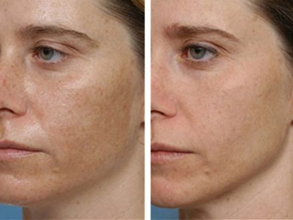 Kémiai hámlasztás az arc az utastérben a technikát alkalmazva, előtt és után, az ajánlások (mély peeling arc fotó szalon után a kémiai peeling felület felülvizsgálat) Kémiai hámlasztás az arc az utastérben a technikát alkalmazva, előtt és után, az ajánlások