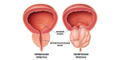 Krónikus prosztatagyulladás az elengedés - hogyan juthat eredmények