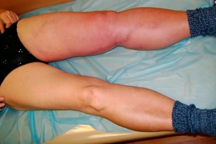 Vénáinak elzáródása a lábak tünetek, kezelés, okait és fotók