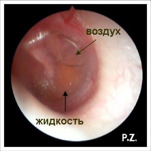 Folyadék a fülben a dobhártya mögött egy gyermek vagy felnőtt kezelés (folyadék a fülben a dobhártya mögött tünetek) Folyadék a fülben a dobhártya mögött egy gyermek vagy felnőtt kezelési