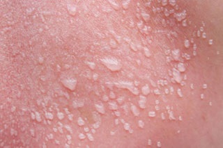Allergiás pattanások az arcon - okok és a kezelés