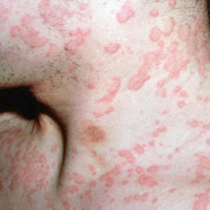 Allergia Diaskintest tünetek