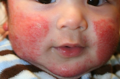 Allergia a gyermeket a hideg tippek