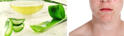 Aloe pattanások az arcon véleménye, alkalmazási szabályainak felülvizsgálata receptek