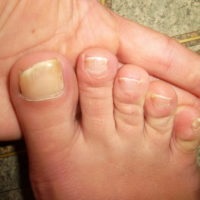 elindított gomba a körmök lábak kezelésében