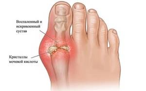 Arthritis toe - okai, tünetei és kezelése