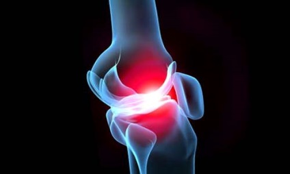 Arthritis - tünetek, kezelés