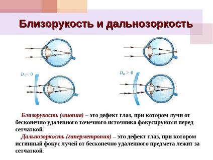 Asztigmatizmus és myopia különbségek alapján