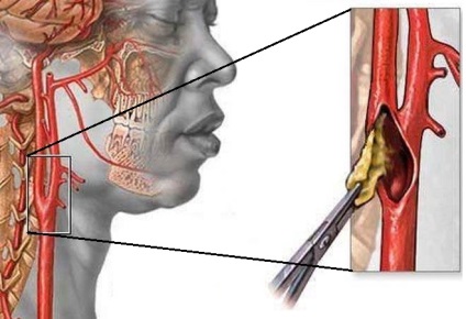 Atherosclerosis BCA mi az összehúzó, tünetei és kezelése extracraniális osztályok