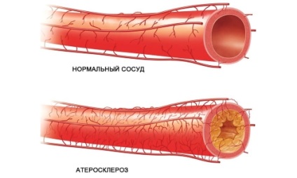 Atherosclerosis A brachiocephalic artériák tünetek és kezelés