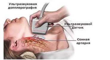 Atherosclerosis A brachiocephalic artériák tünetek és kezelés