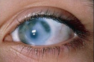 Sorvadás a retina - kezelésére