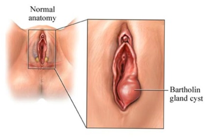 Bartholin mirigy tulajdonságok, funkció, a betegség