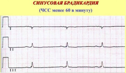 Bradycardia - okai, tünetei és kezelése szívritmus zavarok