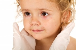 Mint allergia kezelésére és kenetet a gyermek zöldtakarmány és hogyan lehet felismerni a tüneteket