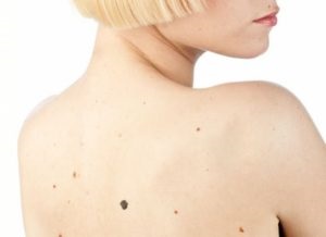 Mi melanomás diagnózis és kezelés