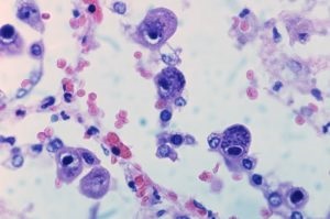 Citomegalovírus (CMV) fertőzés - mi ez, a tünetek a nők és a férfiak