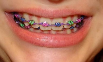 színes fogszabályozó