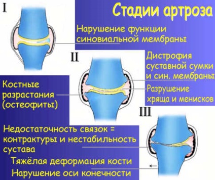 Deformáló arthrosis okai, tünetei, kezelése hagyományos és a népi