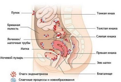 bél endometriózis okoz, jelek, tünetek és a kezelés