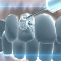 fogászati ​​fluorózis kezelés