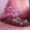 fogászati ​​fluorózis kezelés