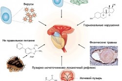 Homeopátia a prosztatagyulladás férfiaknál