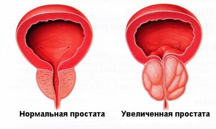 Homeopátia a prosztatagyulladás férfiaknál