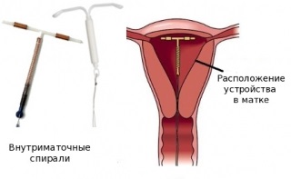 Extraction (eltávolítása) a méhen belüli eszköz (IUD) - árak, ráta, dekódoló, előkészítés,