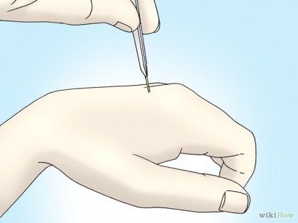 Hogyan szedd ki a kaktusz tűk (howto) Hogyan szedd ki a kaktusz tűk