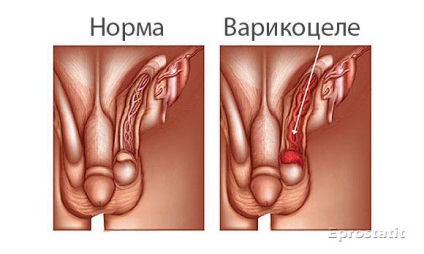 befolyásolja az ureaplasma az erekciót két srác által megszívott péniszeket